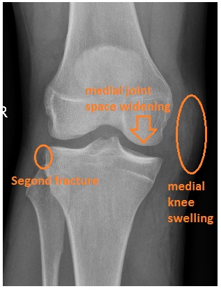 avulsion fracture knee