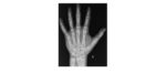 Left hand x-ray