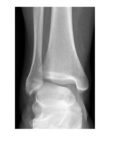 right-ankle-frontal-view