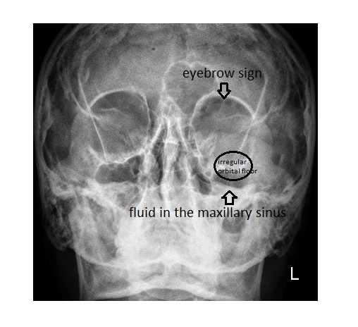 fractured eye socket x ray