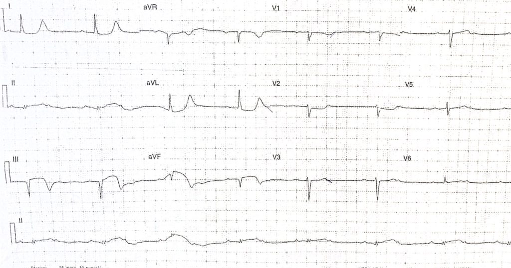 ECG of the Week – 30th June 2021 – Interpretation | Emergucate